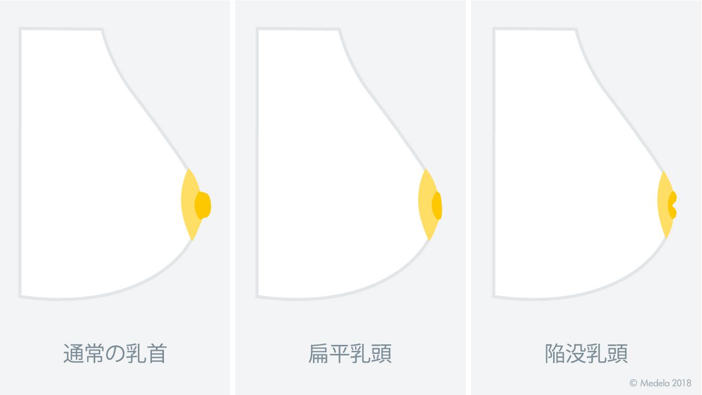 jc敏感乳首 扁平乳頭、陥没乳頭や乳首にピアスの穴がある場合の授乳