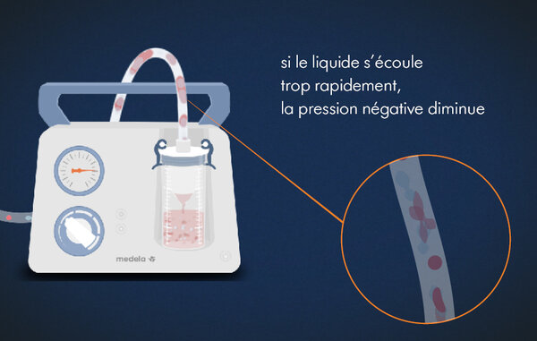Illustration graphique de l'une des étapes de la physique de la technologie du vide médical. Texte de l'image : « si le liquide s'écoule trop rapidement, la pression négative diminue ».