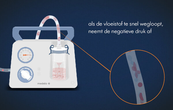 Grafische illustratie van een van de stappen in de fysica van medische vacuümtechnologie. Tekst afbeelding: “als de vloeistof te snel wegloopt, neemt de negatieve druk af”
