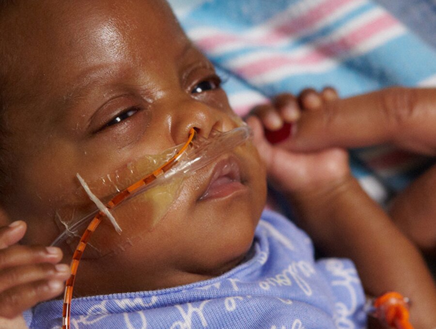 An infant with special feeding needs holds its mother's finger.