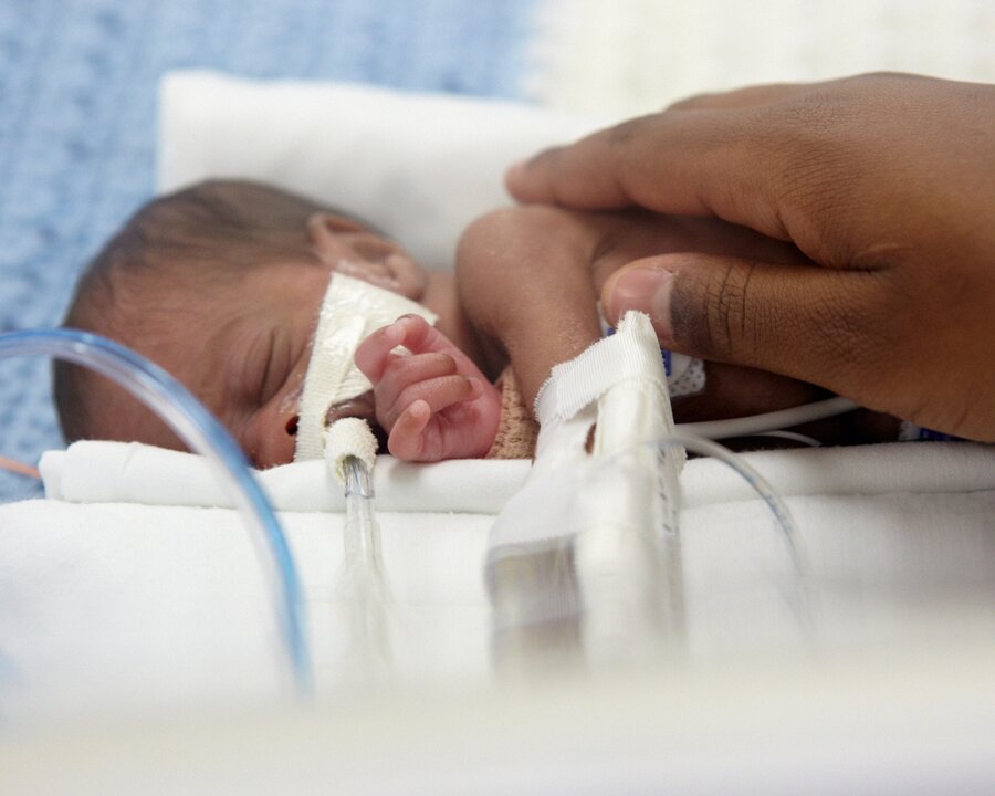 Hand on the back of a premature baby who is connected to multiple medical devices