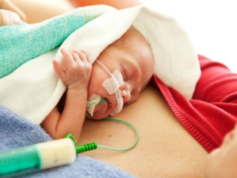 An infant with special feeding needs receives a dose of OMM, its own mother's milk, while lying on its mom's chest.